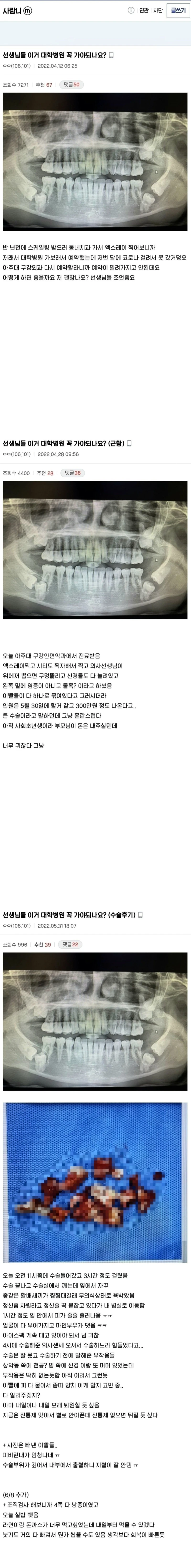 사랑니 수술 레전드.jpg