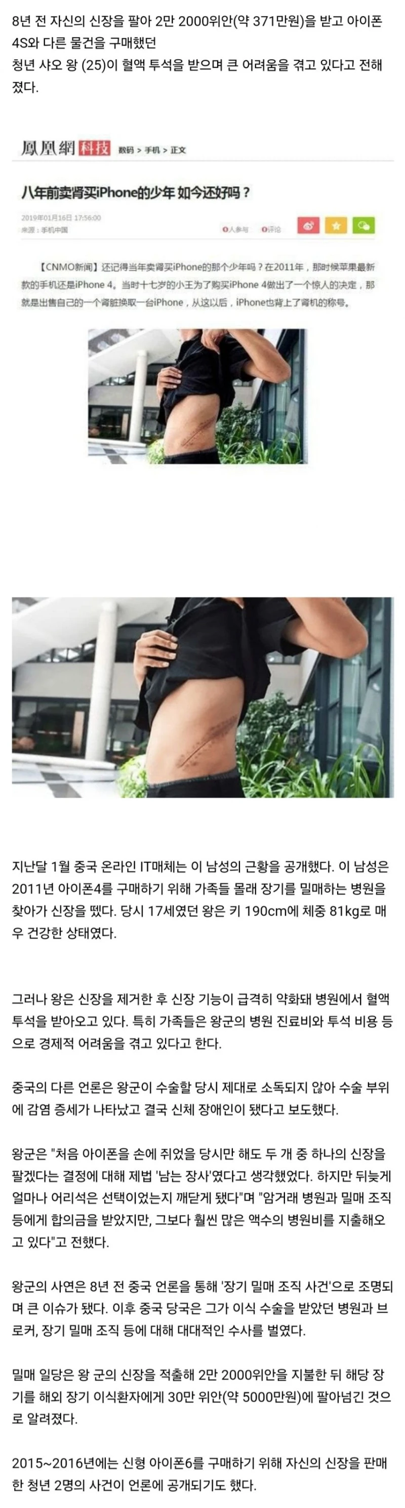 신장 팔아서 370만원 받아 아이폰 산 청년의 뒤늦은 후회.jpg