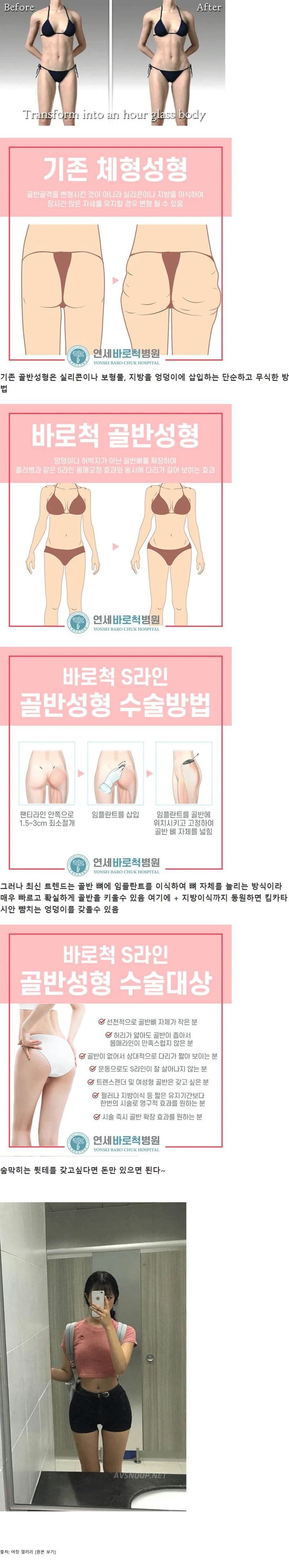 ㅇㅇㅎ?)요즘 골반 성형하는 방법.jpg