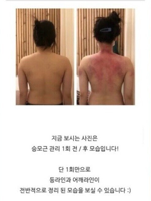 (ㅇㅎ?) 승모근 교정 후기,jpg
