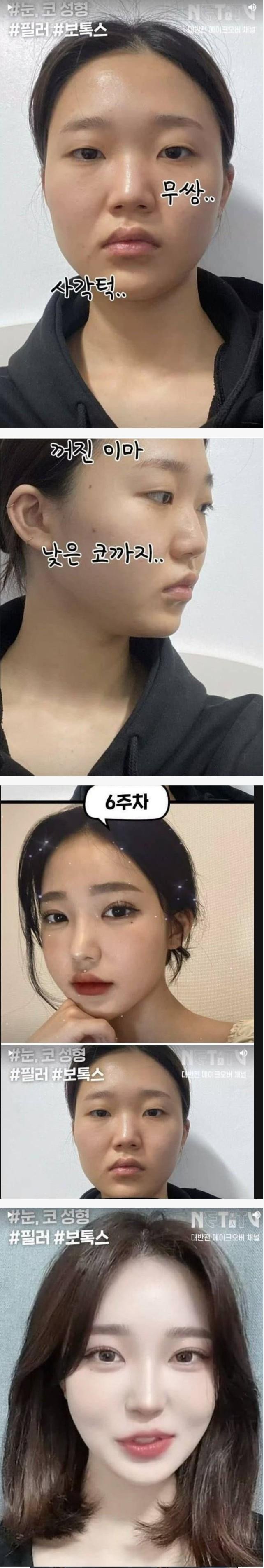 볼때마다 놀라운 성형 비포 에프터.jpg