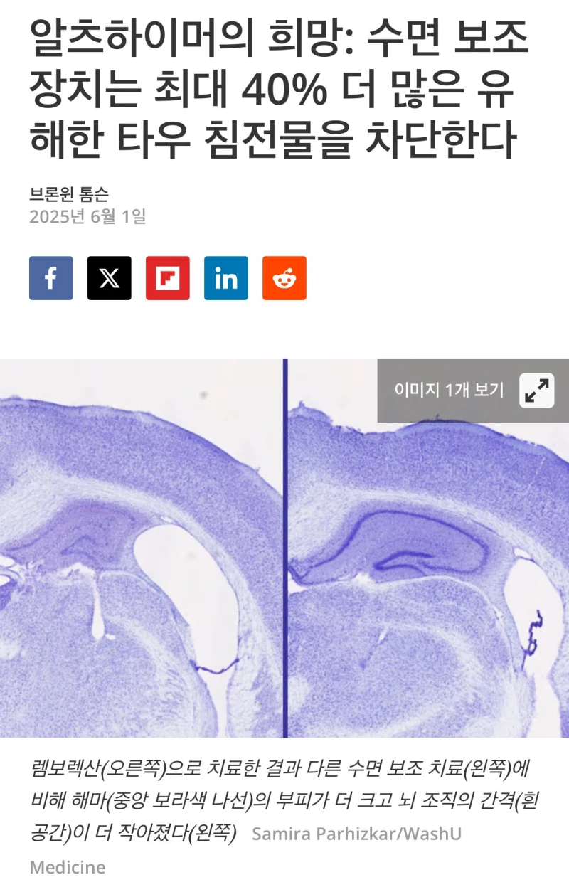 연구결과 불면증약은 치매 유해물질을 최대40% 차단함