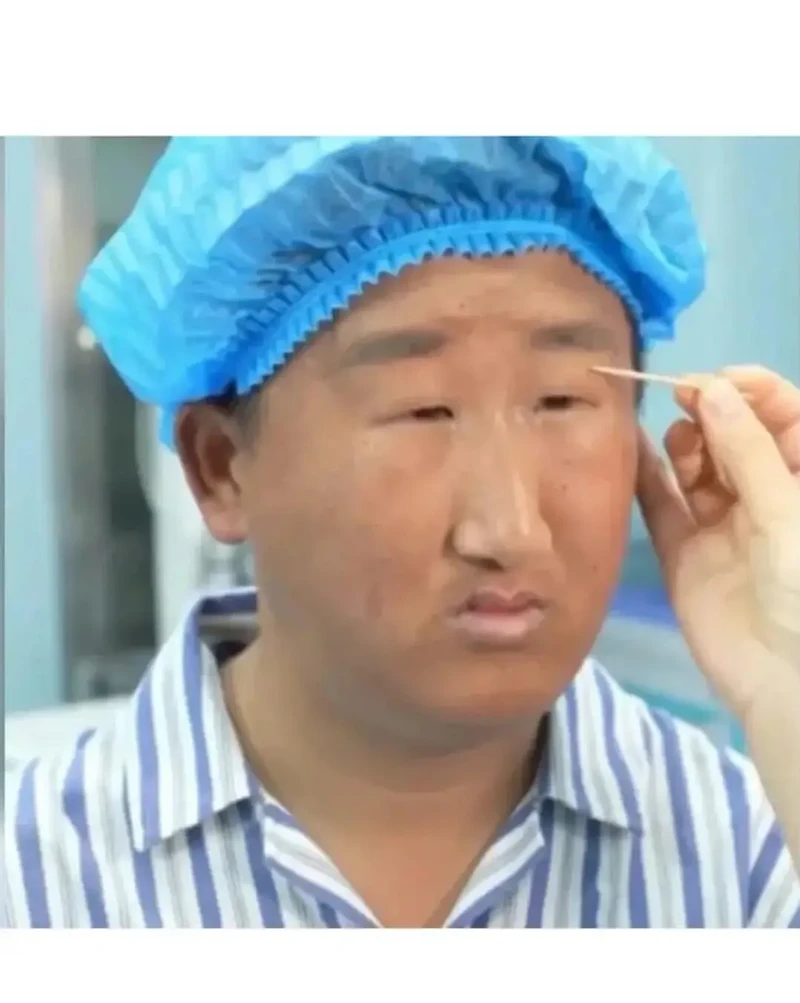 한 중국남성의 쌍커플수술 비포 에프터