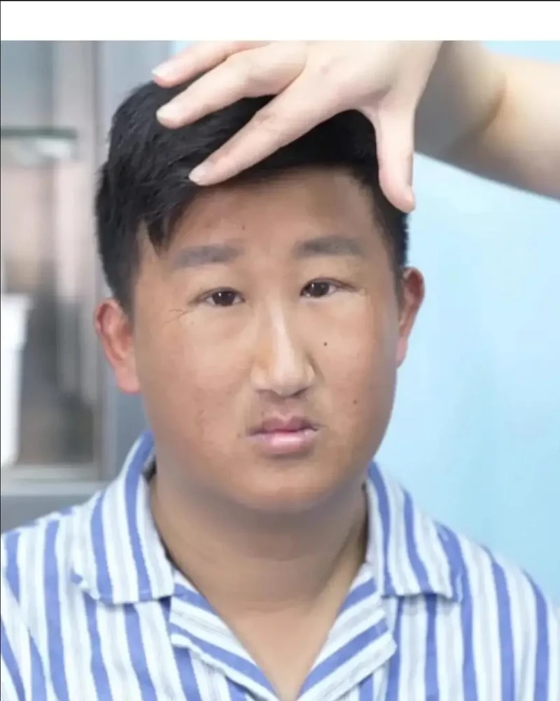 한 중국남성의 쌍커플수술 비포 에프터-2