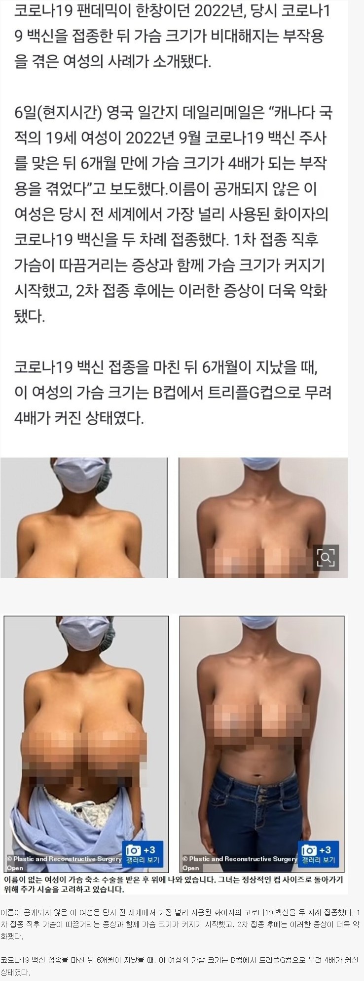 코로나 백신 맞고 유방 3배 커진 여성