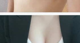 ㄹㅇ 돈이 안아깝다는 가슴수술