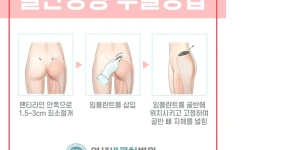 요즘 골반 성형하는 방법