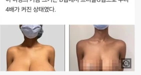 코로나 백신 맞고 유방 3배 커진 여성