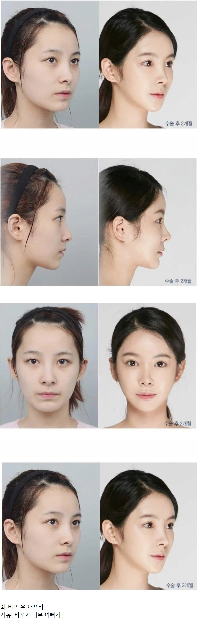 사람들이 너무 안타까워한 성형외과 비포애프터 사진
