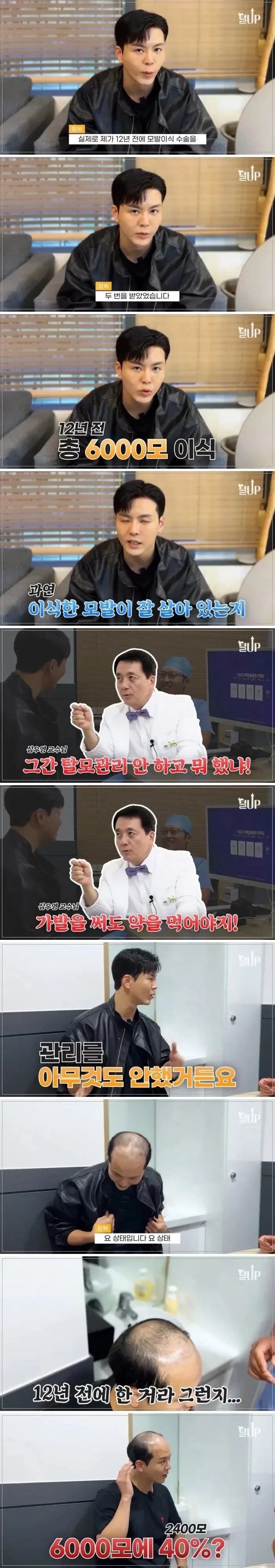 모발 이식후 12년동안 탈모약 안먹음