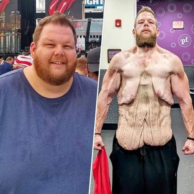 혐주의) 160kg 감량한 사람의 피부 상태
