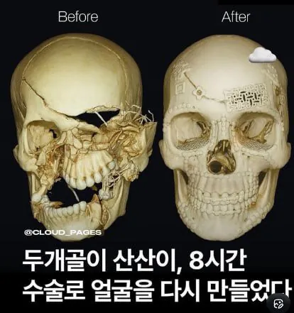 산산조각난 두개골 8시간 수술 