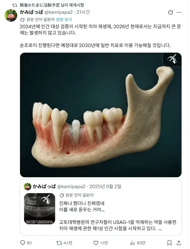 속보) 치아 재생 치료 성공 ㄷㄷ