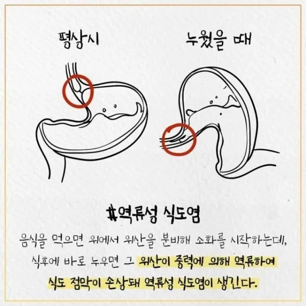 식사 후 바로 누우면 역류성 식도염 발생할 수 있음