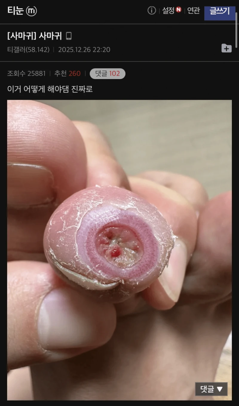극혐주의) 티눈갤 사마귀 인증샷 레전드