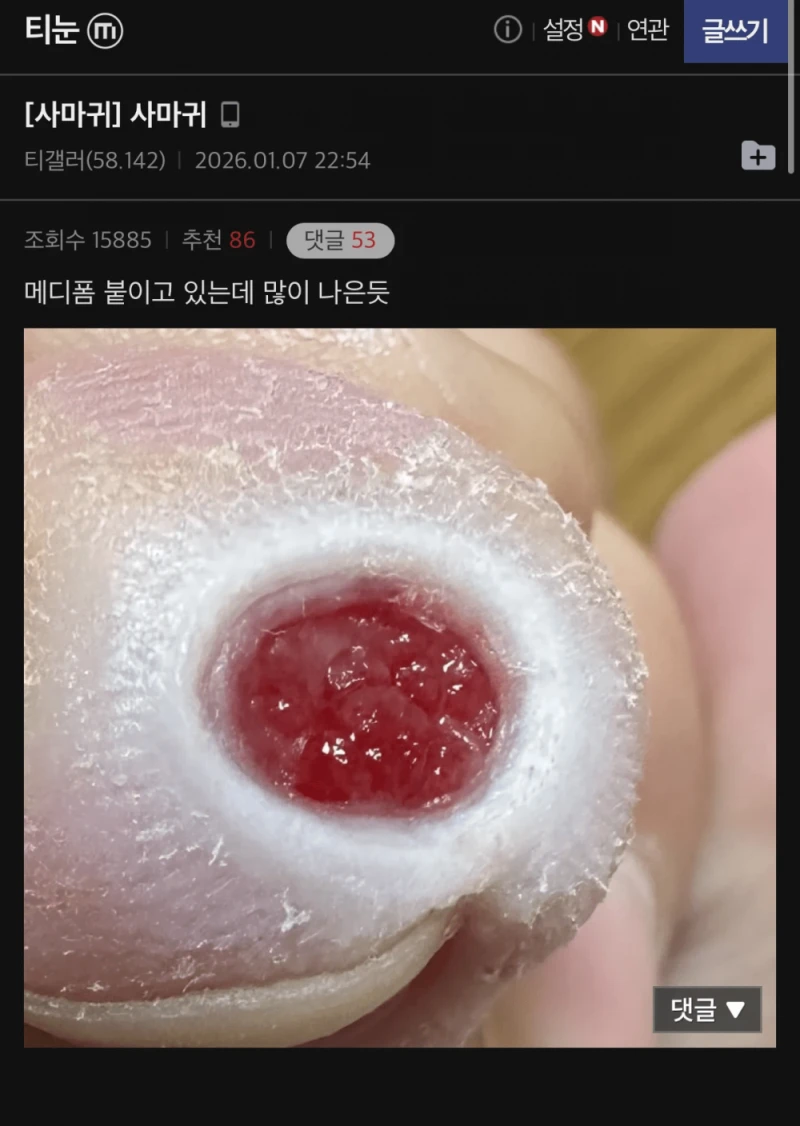 극혐주의) 티눈갤 사마귀 인증샷 레전드-2