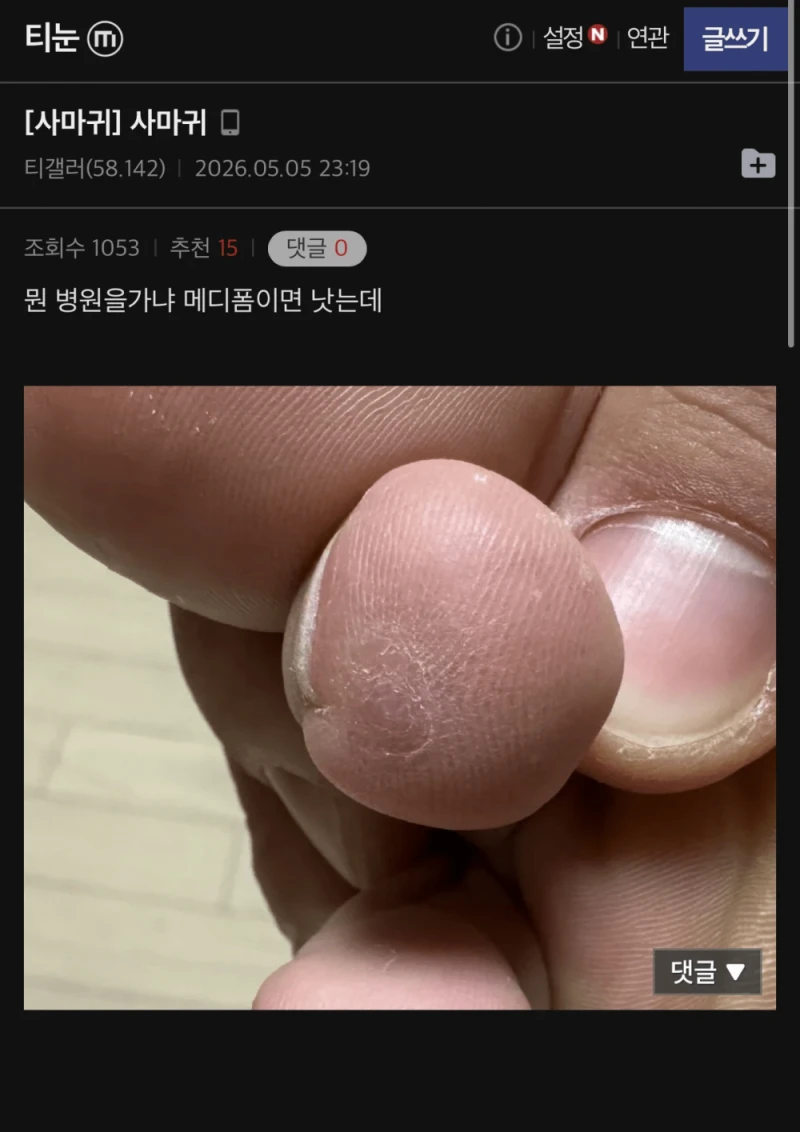 극혐주의) 티눈갤 사마귀 인증샷 레전드-3