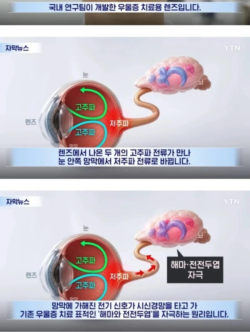 상상도 못한 국내 우울증 치료제 개발 근황