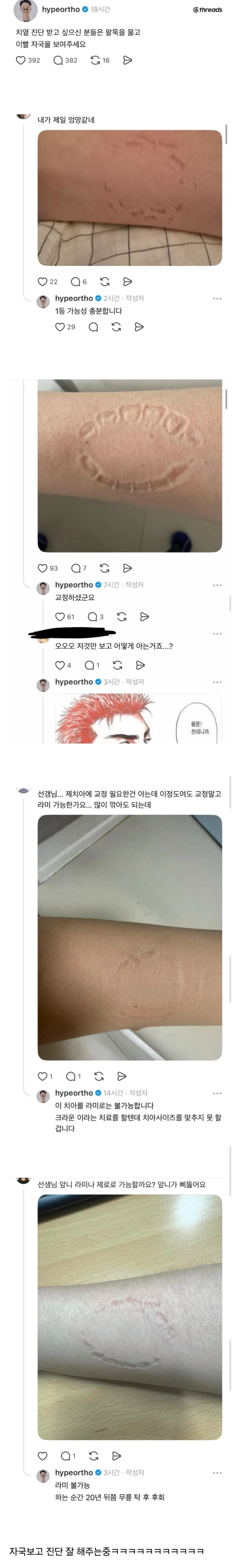 팔뚝을 물고 이빨 자국을 보여주세요.