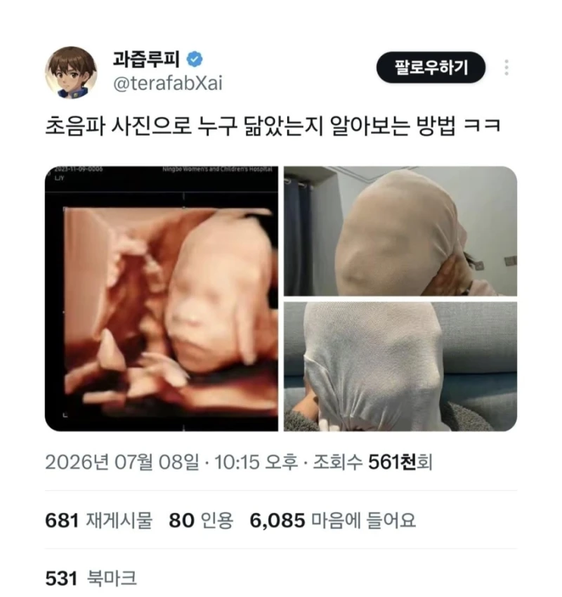 초음파 사진 누구 닮았는지 알아보는 방법