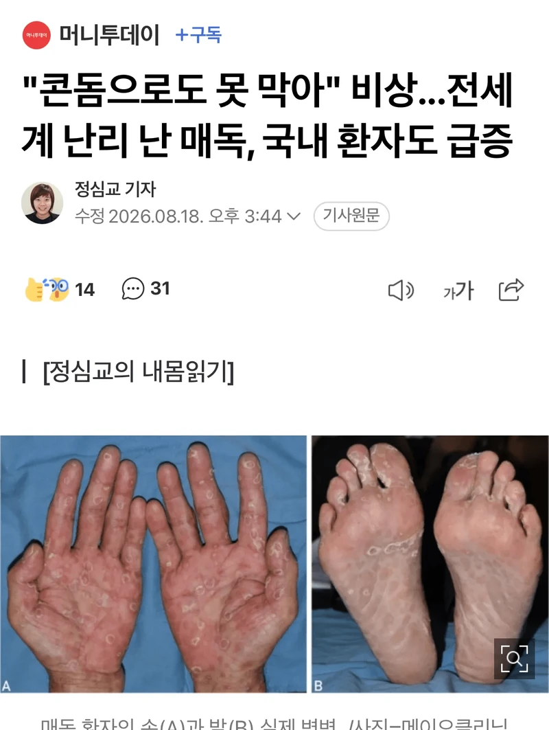 "콘돔으로도 못 막아" 전세계 난리