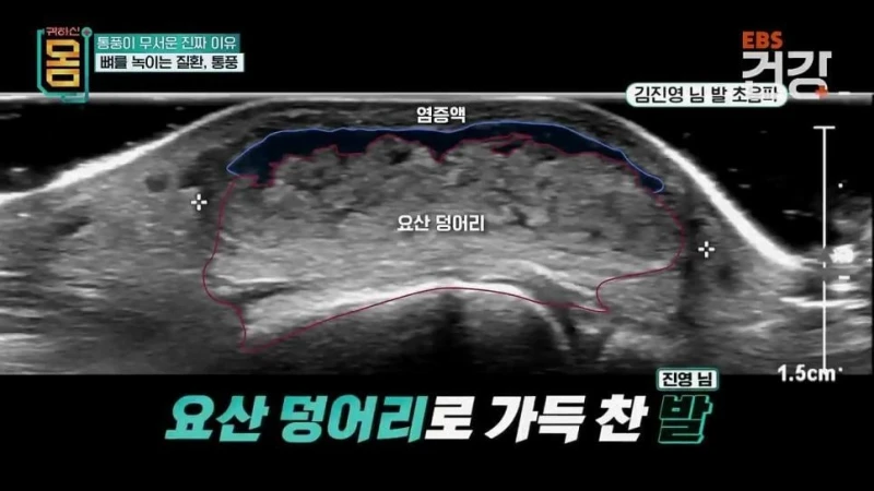 30대 통풍 환자의 발상태 .jpg-7
