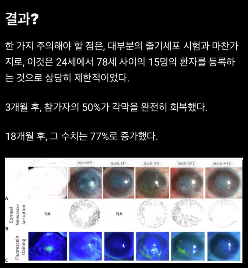 줄기세포로 불가능했던 각막치료 성공 소식-4