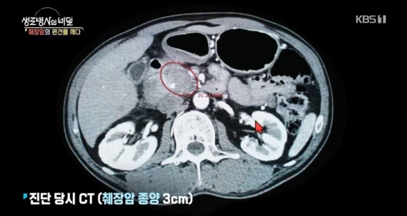 췌장암 3기 판정받은 사람이 느낀 증상-6