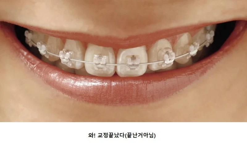 대부분 모르는 치아 교정인들의 삶