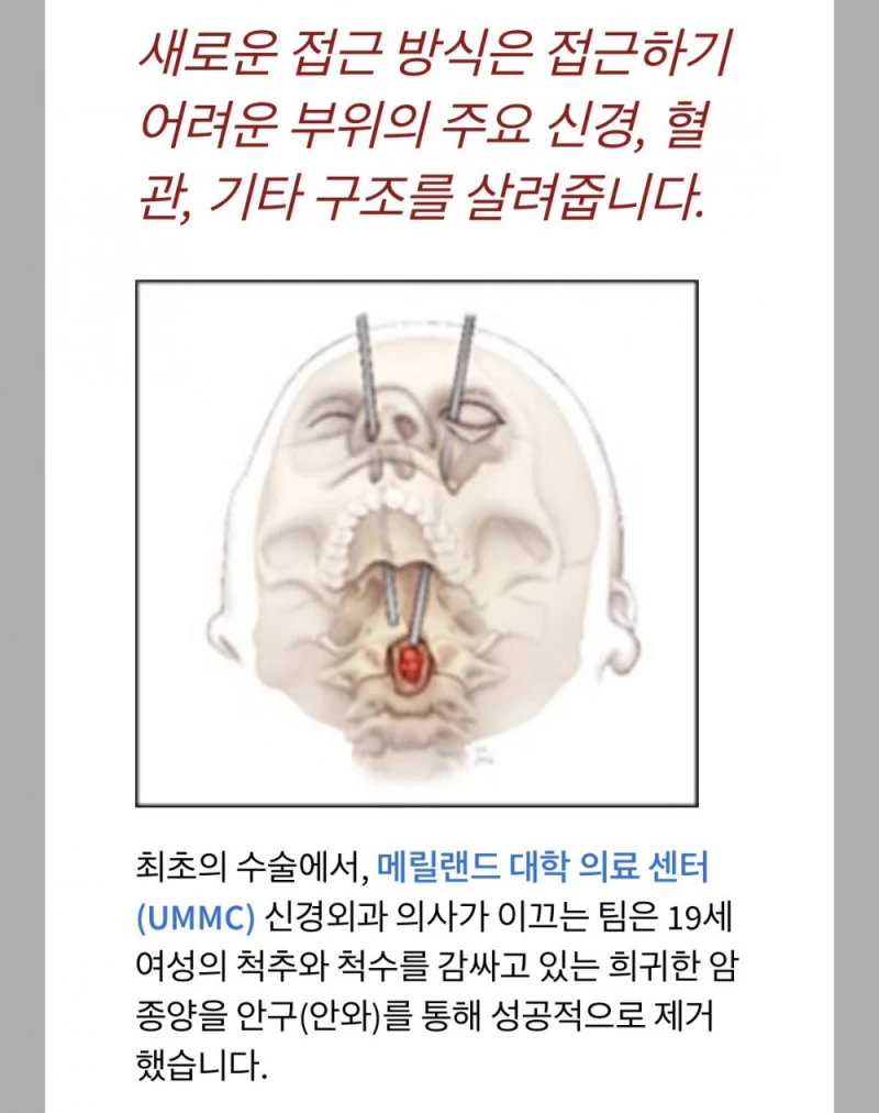세계 최초로 눈구멍을 통해 척추종양 제거-3
