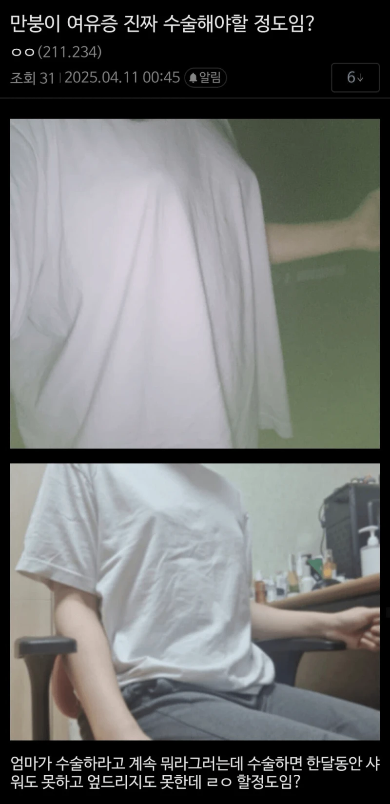 여유증 수술해야 할 정도인지 궁금한 사람