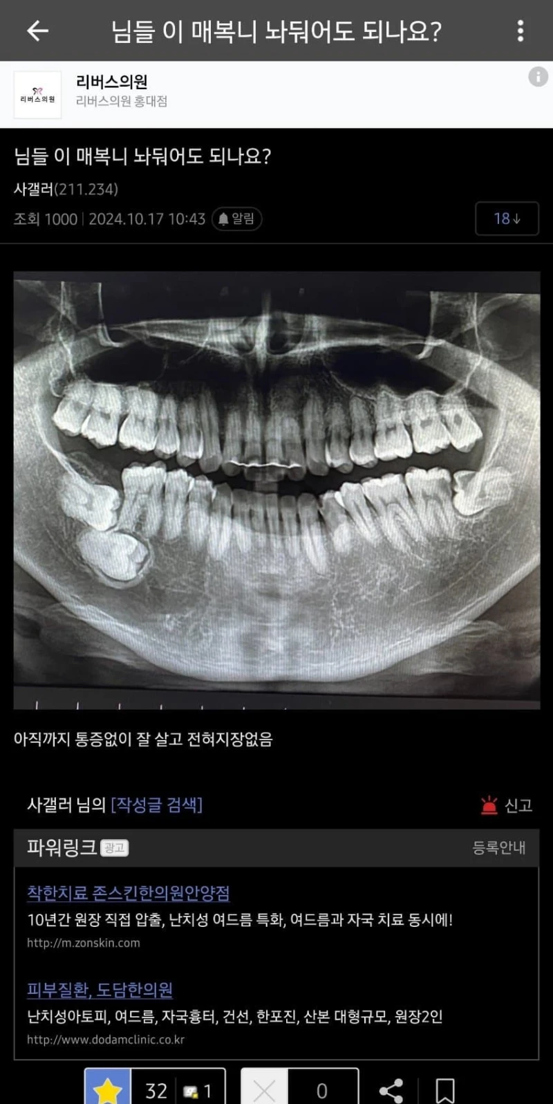 싱글벙글 익스트림 사랑니갤