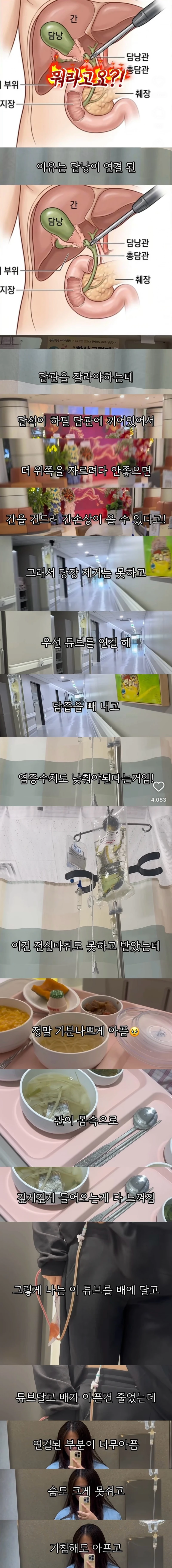 위고비 마운자로 맞고 배에 구멍난 썰-3